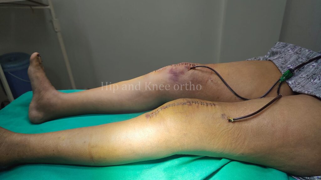 knee replacement surgery