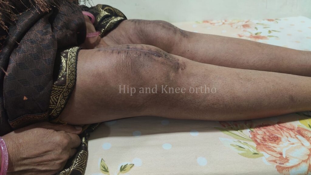 knee replacement surgery in Indore