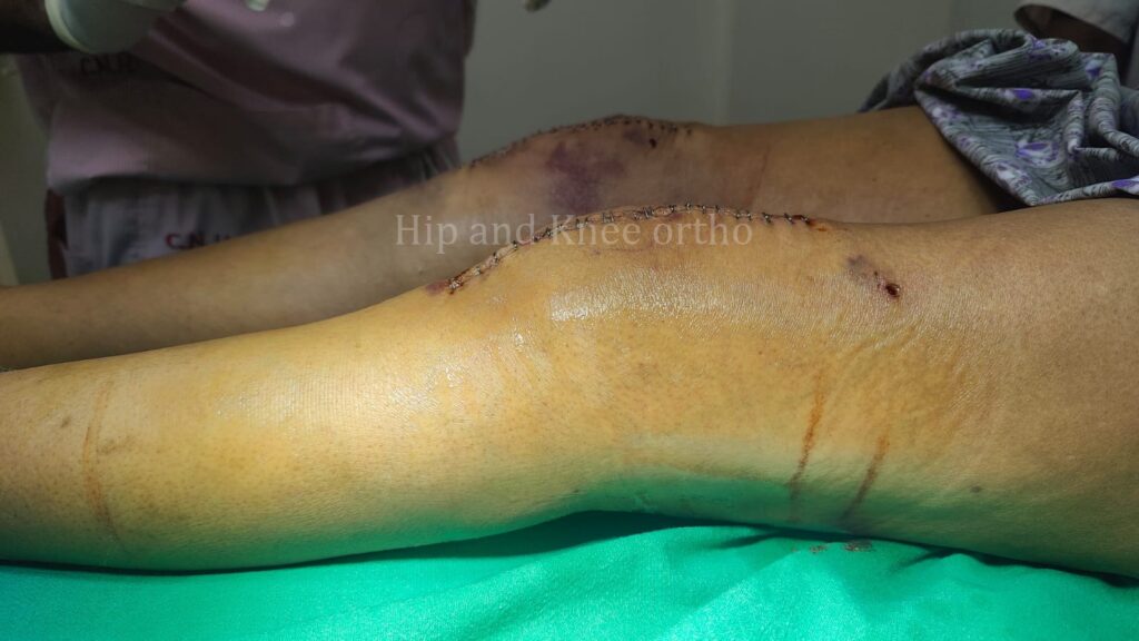 knee replacement surgery indore