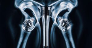 robotic knee and hip replacement surgery, orthopedic surgery in indore
