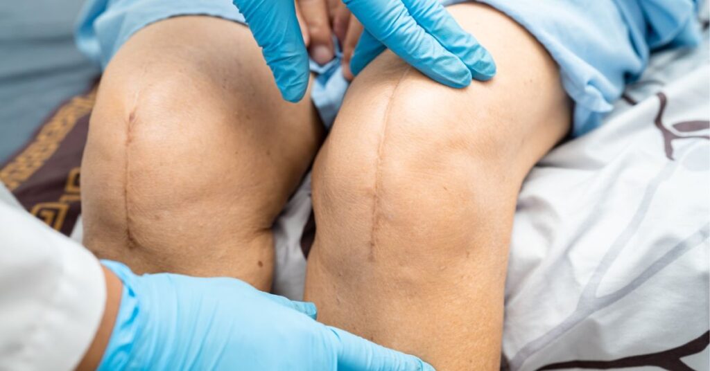 best knee replacement doctor in indore
