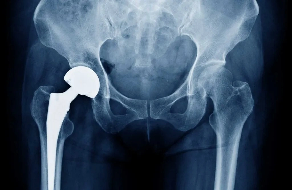 Hip Replacement Surgery in Indore