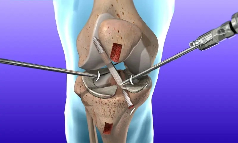 Best Ligament Surgery in Indore