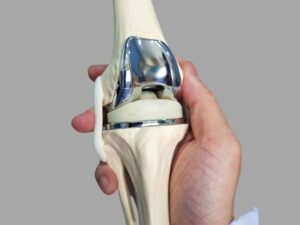 Best Knee Replacement Surgery in Indore