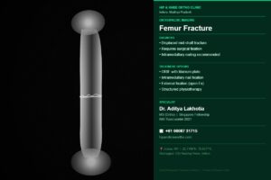 X-ray image showing femur shaft fracture — fracture treatment in Indore by Dr. Aditya Lakhotia, best orthopaedic doctor