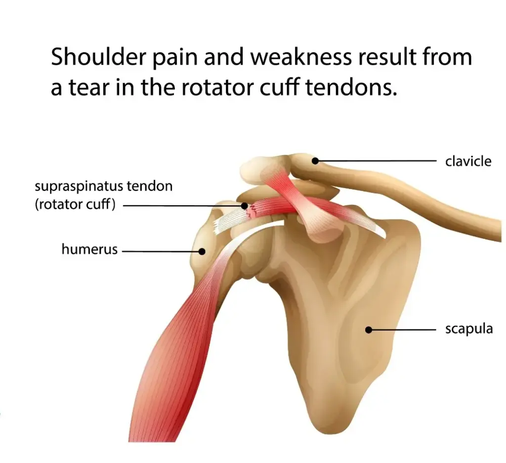 Rotator Cuff Repair Treatment in Indore by shoulder arthroscopy specialist