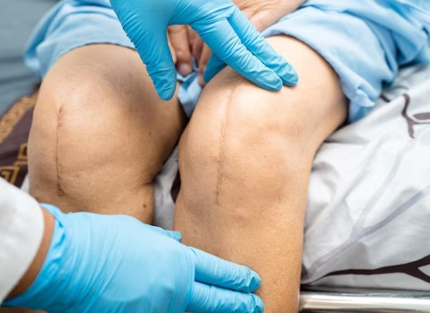 Best Knee Replacement Surgery in Indore
