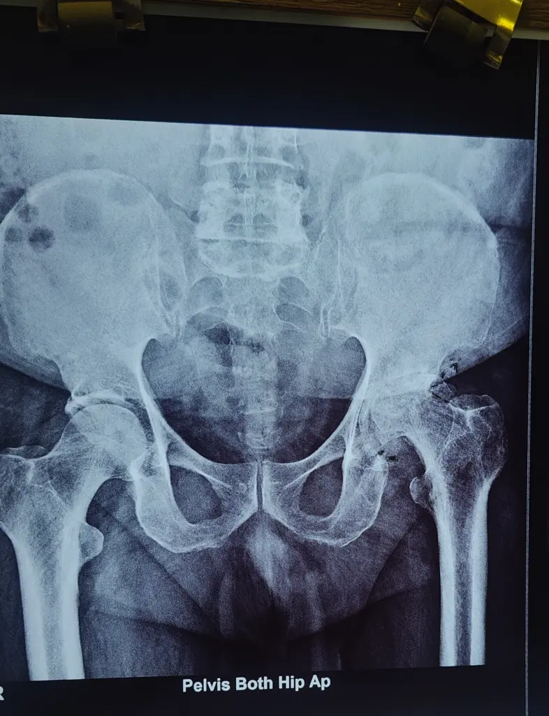 Total Hip Replacement Surgery in Indore for primary, complex, and revision hip replacement procedures