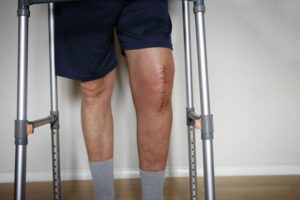 Knee Replacement Surgery in Indore