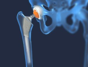 Hip Replacement Surgery in Indore