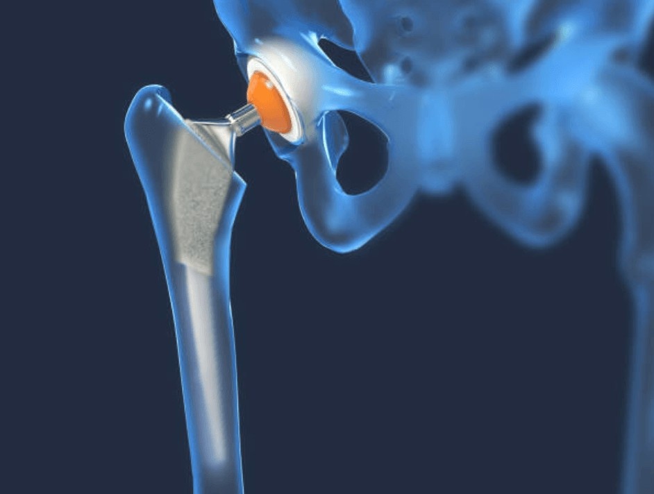 Hip Replacement Surgery in Indore