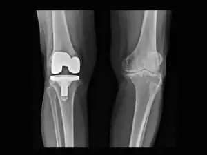 Best Knee Replacement Surgery in Indore