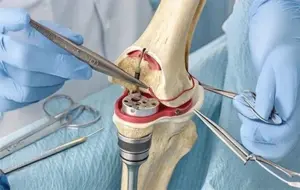 Knee Replacement Surgery in Indore