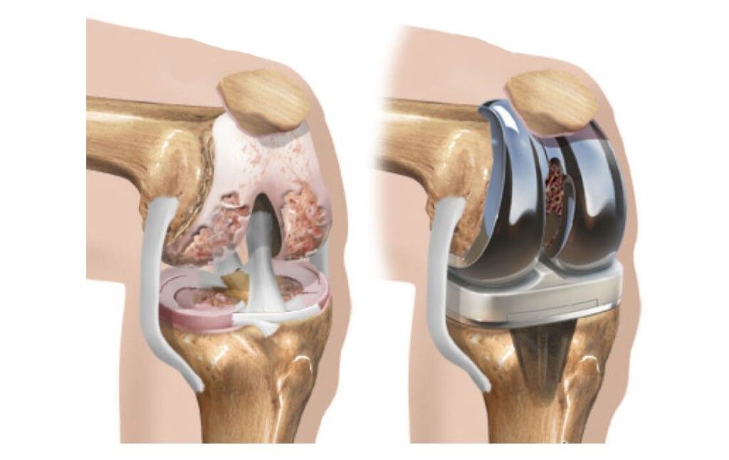 Knee Replacement Surgery in Indore