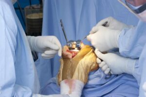 Best Knee Replacement Surgery in Indore