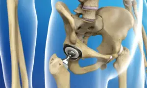 Hip Replacement Surgery in Indore