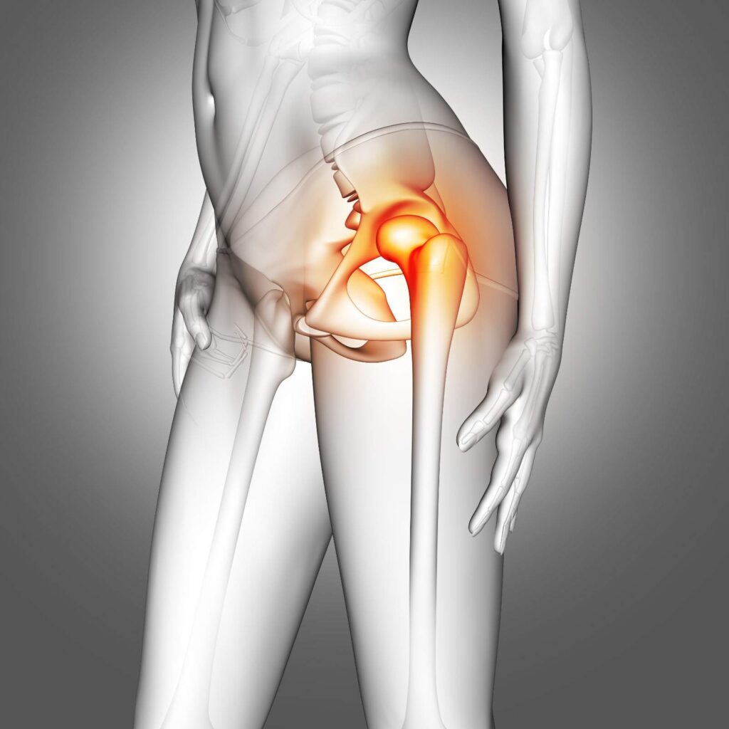 Best Hip Replacement Surgery in Indore