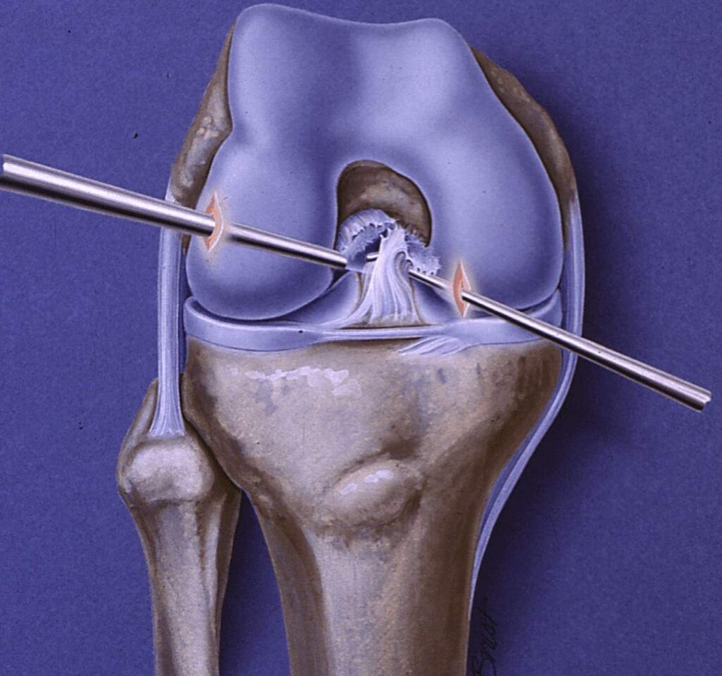 Ligament Surgery in Indore