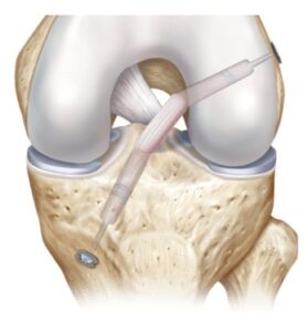 Ligament Surgery in Indore