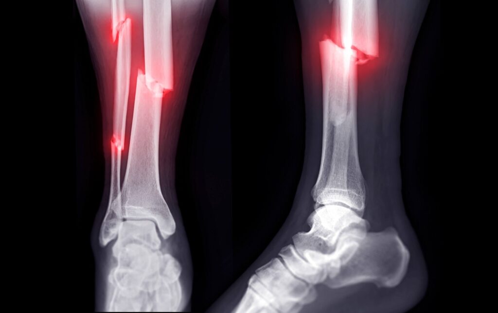 Best Fracture Surgery in Indore