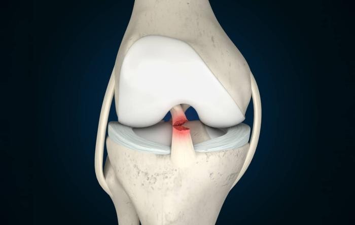 Ligament Surgery in Indore