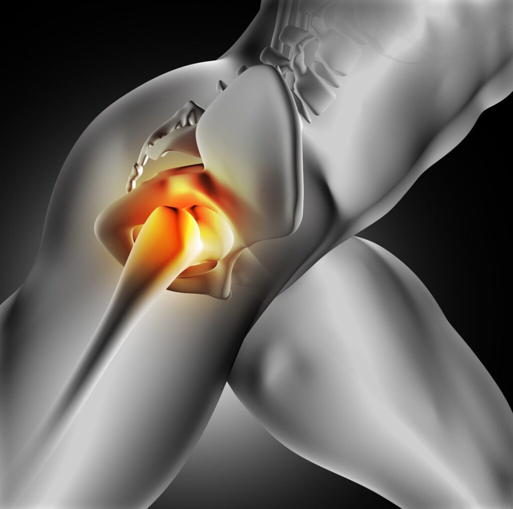 Hip Replacement Surgery in Indore